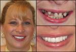 Implants & Full Mouth Reconstruction