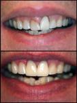 Laser Treatment - Gingival Recontouring